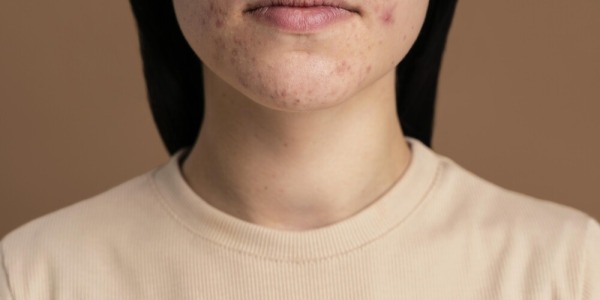 Acné: más allá de los granitos