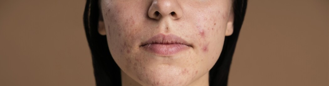 Acné: más allá de los granitos